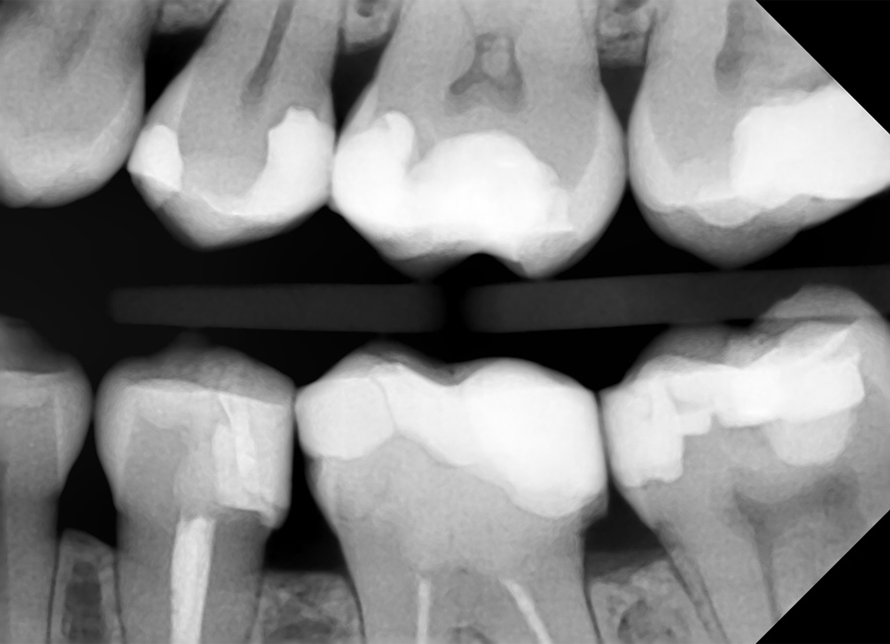 Radiografia digitala bitewing/ muscata