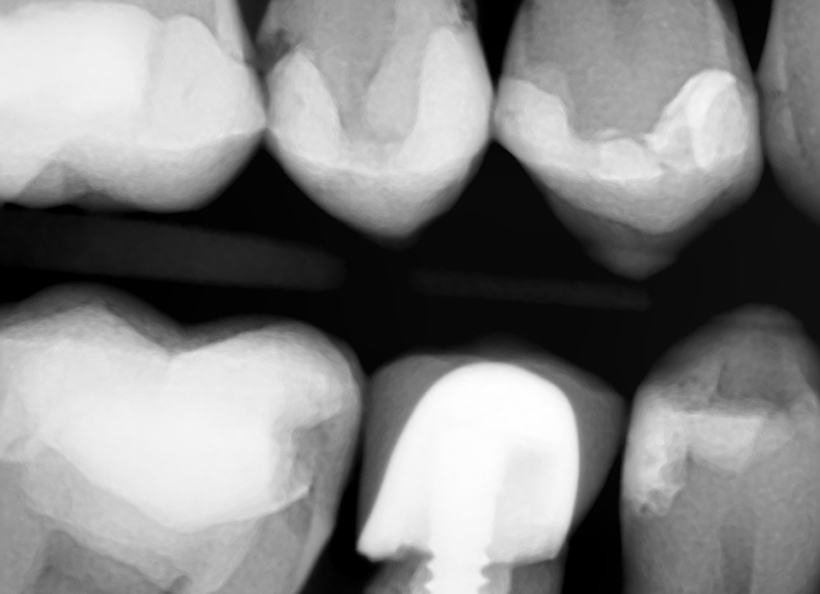 Radiografia digitala bitewing/ muscata
