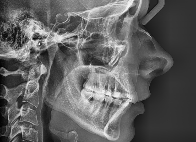 Radiografia digitală de profil sau teleradiografie (cefalometria) de profil