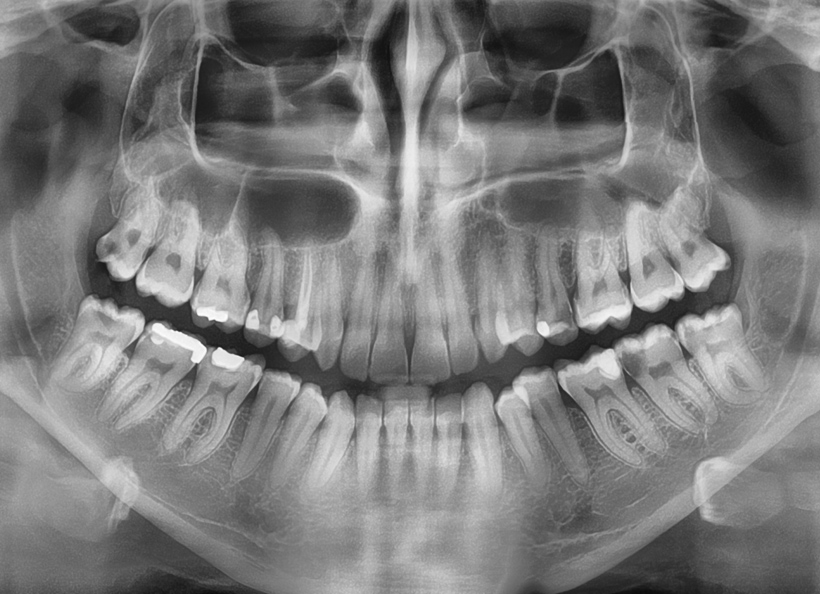 Radiografia digitala panoramica (opt)
