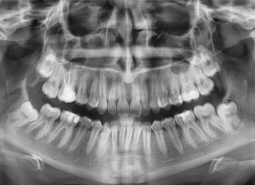 Radiografia panoramica O.P.T. pentru sinusurile maxilare