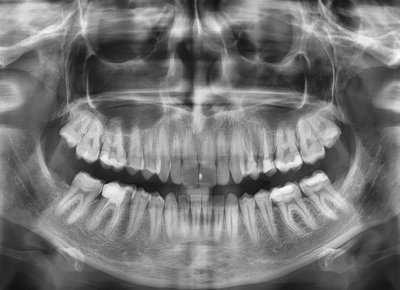 Radiografii digitale panoramice (opt)