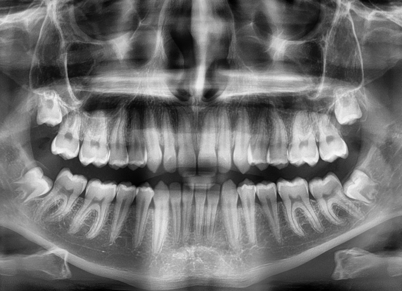 Radiografii panoramice O.P.T. pentru sinusurile maxilare