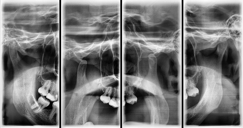 Radiografia articulatiilor temporomandibulare A.T.M.