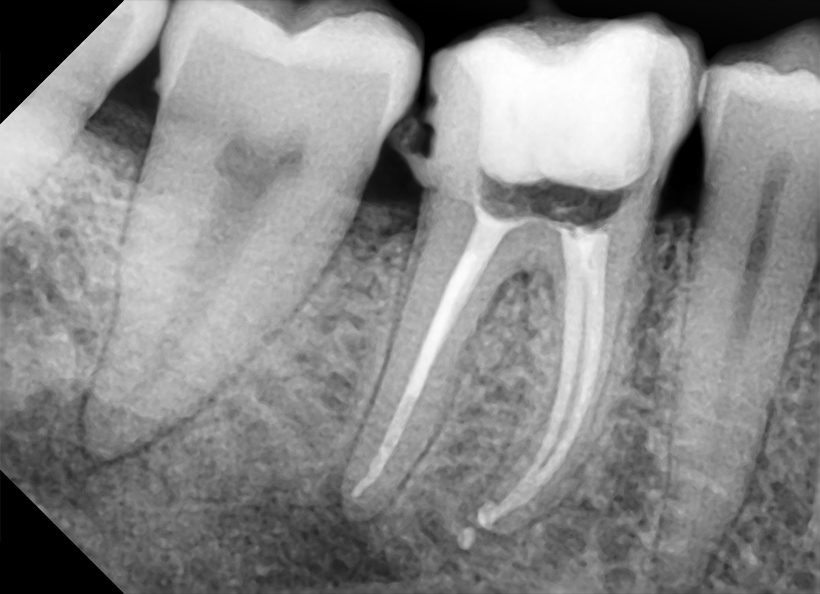 Radiografia digitala retroalveolara