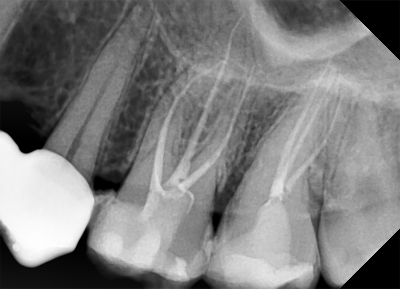 Radiografia digitala retroalveolara