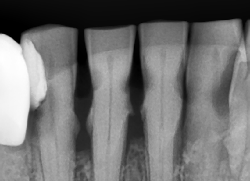Radiografia digitala retroalveolara