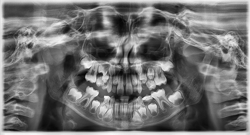 Radiografia digitala panoramica O.P.T. pediatric