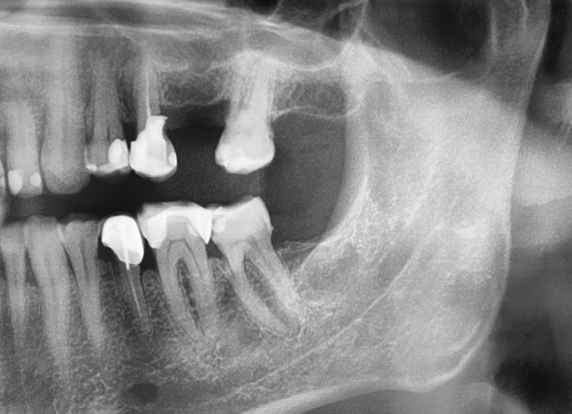 Radiografia digitala panoramica O.P.T. sectionala