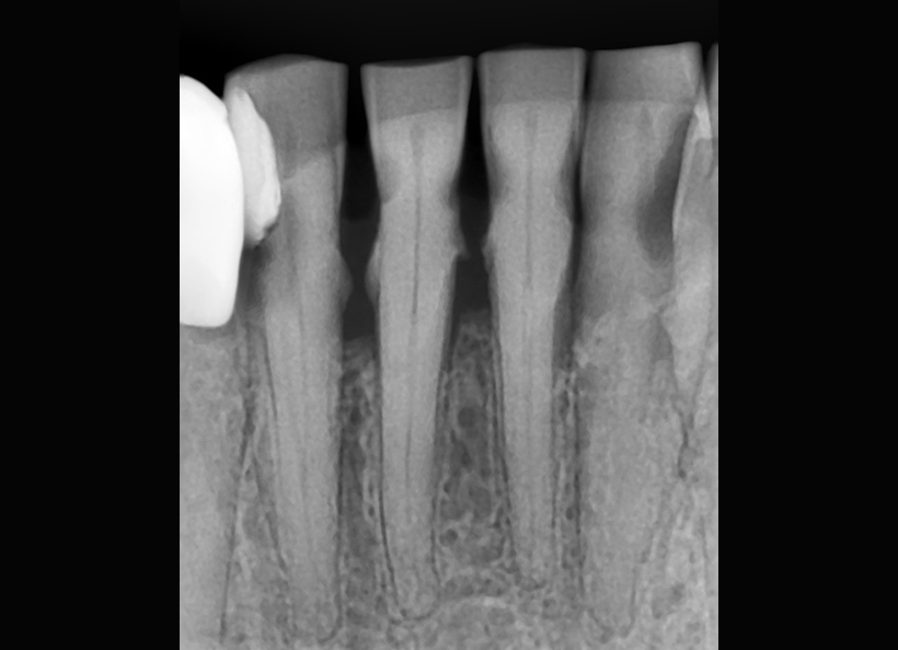 Radiografia digitala retroalveolara