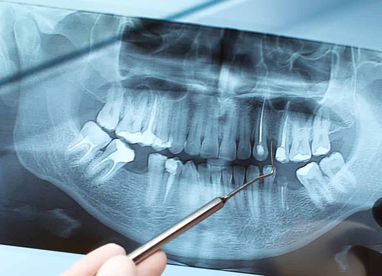 Radiografii dentare digitale