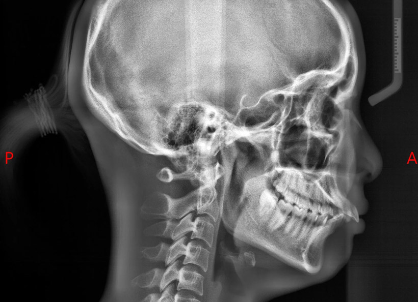 Radiografia cefalometrică - teleradiografia