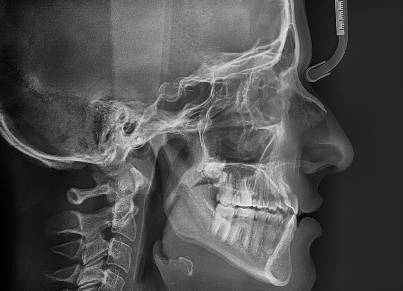 Radiografii cefalometrice - teleradiografii