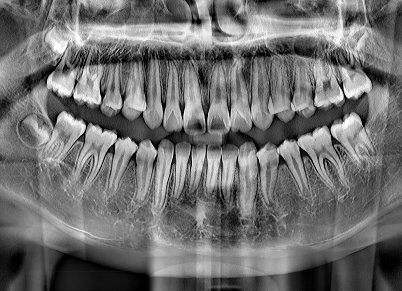 Radiografie digitală panoramică (opt)
