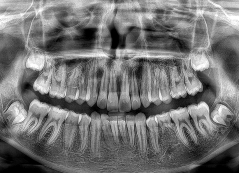 Radiografii digitale panoramice (opt)