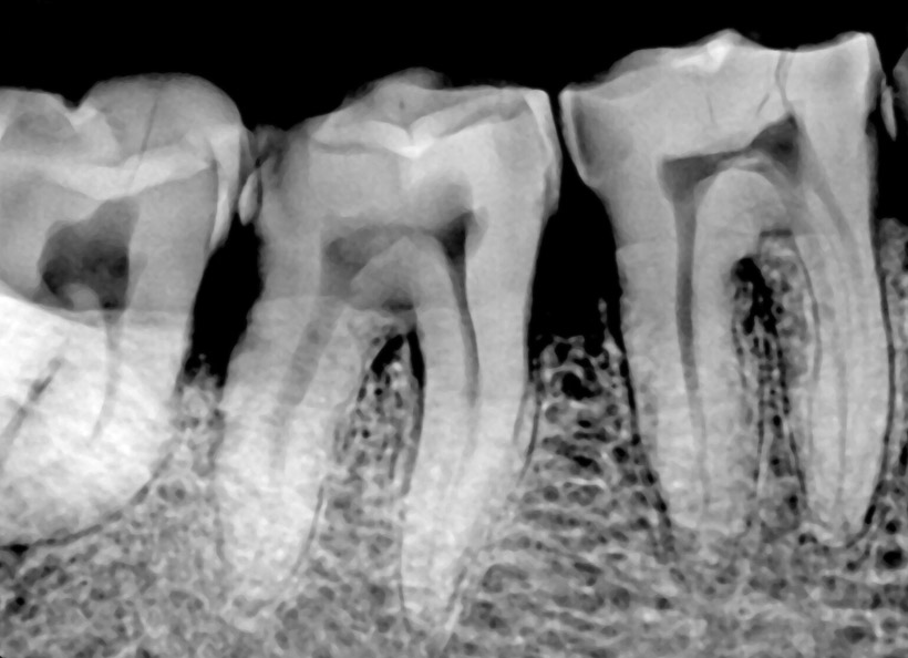 Radiografii digitale retroalveolare