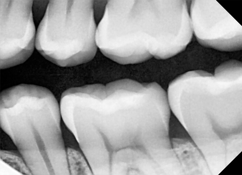 Radiografie digitală bitewing