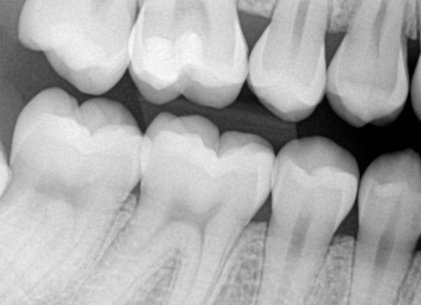 Radiografii digitale retroalveolare bitewing