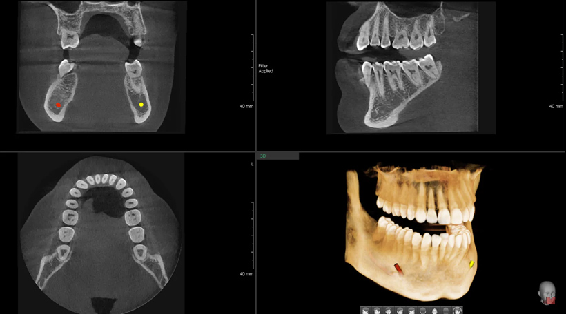 Tomografia Computerizată CBCT - CT 3D